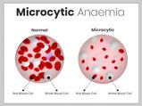 Microcytic Anemia: Symptoms, Causes, Risk Factors, Treatment, And Prevention