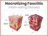 Necrotizing Fasciitis: Causes, Symptoms, Diagnosis, Treatment And Prevention