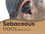 Sebaceous Horn (Devil’s Horn): Causes, Symptoms, Risk Factors, Treatment, And Prevention
