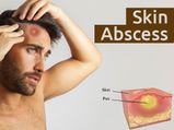Skin Abscess: Causes, Symptoms, Diagnosis, Prevention And Treatment 