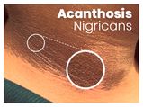 Acanthosis Nigricans: Causes, Symptoms, Risk Factors, Diagnosis, Treatment And Prevention