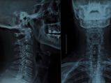 World Radiography Day: Advantages And Disadvantages Of X-rays