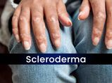 Scleroderma: Types, Causes, Symptoms, Diagnosis, Treatment And Management