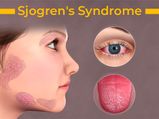 What Is Sjogren's Syndrome? Causes, Symptoms, Diagnosis And Treatment