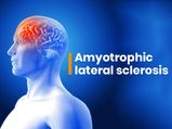 Amyotrophic Lateral Sclerosis: Causes, Symptoms, Diagnosis And Treatment 