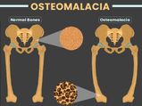 Osteomalacia: Causes, Symptoms, Risk Factors, Diagnosis And Treatment