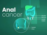 Anal Cancer: Causes, Symptoms, Diagnosis And Treatment
