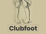 Clubfoot: Causes, Symptoms, Risk Factors, Diagnosis, Treatment And Prevention