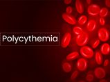 Polycythemia: Causes, Symptoms, Risk Factors, Diagnosis, Treatment And Prevention