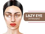 Lazy Eye (Amblyopia): Causes, Symptoms, Risk Factors, Diagnosis And Treatment