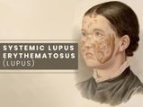 Systemic Lupus Erythematosus: Causes, Symptoms, Complications, Treatments And Prevention