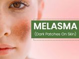 Melasma (Chloasma): What Are The 6 Factors That Cause It? Symptoms, Treatments And Prevention