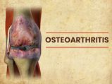 Osteoarthritis (Knee Osteoarthritis): Causes, Symptoms, Diagnosis, Treatment And Prevention 