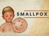Smallpox: History, Causes, Symptoms, Diagnosis And Treatment