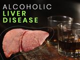 Alcoholic Liver Disease: Causes, Stages, Symptoms, Risk Factors, Diagnosis And Treatment 
