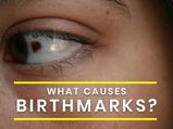Do You Have A Birthmark? It May Be An Indication Of Underlying Medical Problem 
