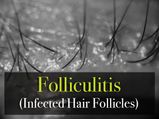 Folliculitis (Infected Hair Follicles): Is It A Major Concern? Causes, Symptoms And Treatments