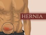 Hernia: Types, Causes, Symptoms, Risk Factors, Diagnosis And Treatment 