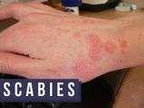 Scabies: Causes, Transmission, Symptoms, Diagnosis, Treatment And Prevention