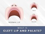 National Cleft And Craniofacial Awareness and Prevention Month: What Is Cleft Lip And Palate?