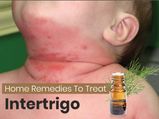 How To Treat Intertrigo: Safe And Effective Home Remedies