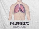 Pneumothorax (Collapsed Lung): Types, Causes, Symptoms, Risk Factors And Treatments