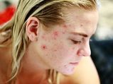How To Deal With Sudden Acne Breakout