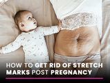 How To Get Rid Of Stretch Marks Post Pregnancy: Ayurvedic Oils, Herbs And Natural Ingredients