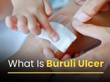 What To Know About Buruli Ulcer: Flesh-Eating Disease Spreading In Australia