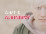 International Albinism Awareness Day 2021: What Is Albinism? Causes, Symptoms And Treatments