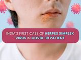 India Reports First Case of Herpes Simplex Virus In COVID-19 Patient: All About Herpes Explained