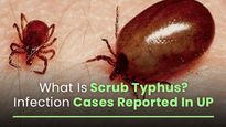 Scrub Typhus; Know About The Cause, Symptoms And Prevention Of The Mystery Fever Reported In UP