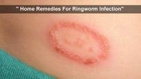 14 Safe And Effective Home Remedies For Ringworm Infection: Garlic, Tea Tree Oil, Salt And More