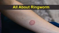 All About Ringworm: Causes, Symptoms, Risk Factors, Diagnosis, Treatments And Prevention
