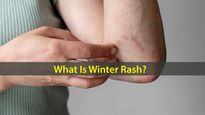 What Is Winter Rash? Causes, Symptoms, Risk Factors And Treatments
