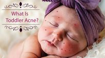 What Is Toddler Acne? Causes, Symptoms, Complications, Diagnosis And Treatments
