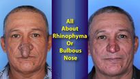 NY Man Treated For Rhinophyma Or Bulbous Nose: Causes, Symptoms And Treatment Of The Condition