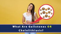 What Are Gallstones Or Cholelithiasis? Causes, Symptoms, Risk Factors, Complications And Treatments