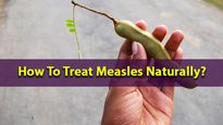 Measles Immunisation Day 2022: How To Treat Measles Naturally?