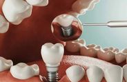 Expert Article: What Are Tooth Implants? When And Why You Should Get Them