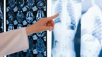 Why People With Lung Disorder Face Risk Of Severe Covid-19 Found