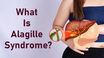 What Is Alagille Syndrome? Causes, Symptoms, Diagnosis And Treatment