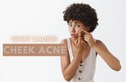 Got Cheek Acne? Here's How You Can Manage It