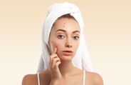 Four Mistakes To Avoid If You Have Acne-Prone Oily Skin