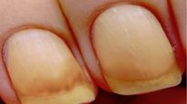 What Is Yellow Nail Syndrome? Causes, Symptoms, Complications, Diagnosis And Treatments