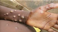 Monkeypox: Kerala Steps Up Vigil, Issues Special Alerts To Five Districts