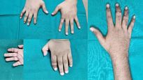 National Plastic Surgery Day 2022: Microsurgical Techniques For Attaching Amputated Fingers