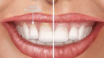 Expert Article: Receded Gums, Its Causes, Symptoms, Diagnosis And Treatment