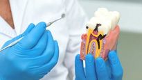 Expert Article: What Is Root Canal Therapy? Can A Root Canal Treated Tooth Pain Again? 