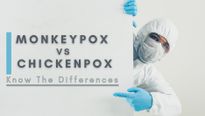 Monkeypox vs Chickenpox: Know The Difference; If You Had Chickenpox, Are You Safe?